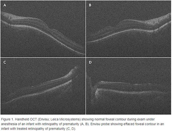 How a Landmark Study Changed Diabetic Eye Care: DRCRnet Protocol I